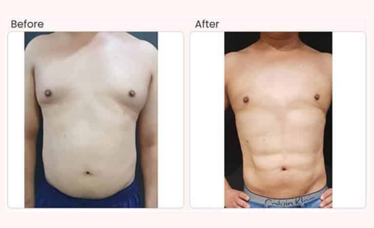 six-pack abs procedures - Ultimate Guide for Abdominoplasty - Dr Rajat Gupta - Plastic Surgeon in Delhi -012