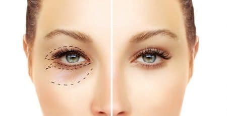 Blepharoplasty Surgery