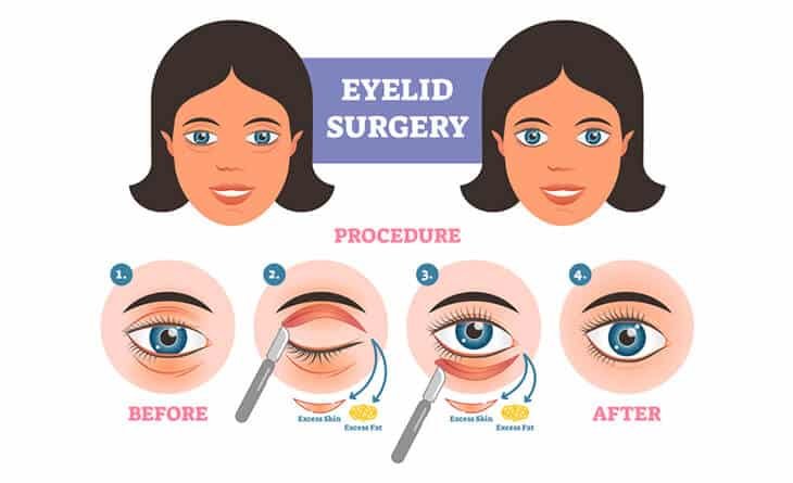 Whats it Like to Have an Upper Eyelids Blepharoplasty - Dr Rajat Gupta - Best Plastic Surgeon in Delhi -01 Upper Eyelids Blepharoplasty