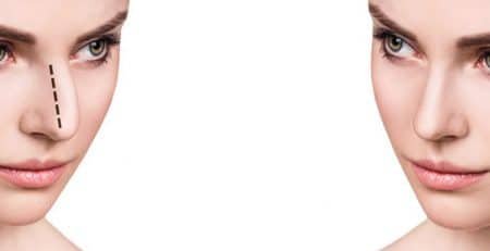 Rhinoplasty Surgery in India