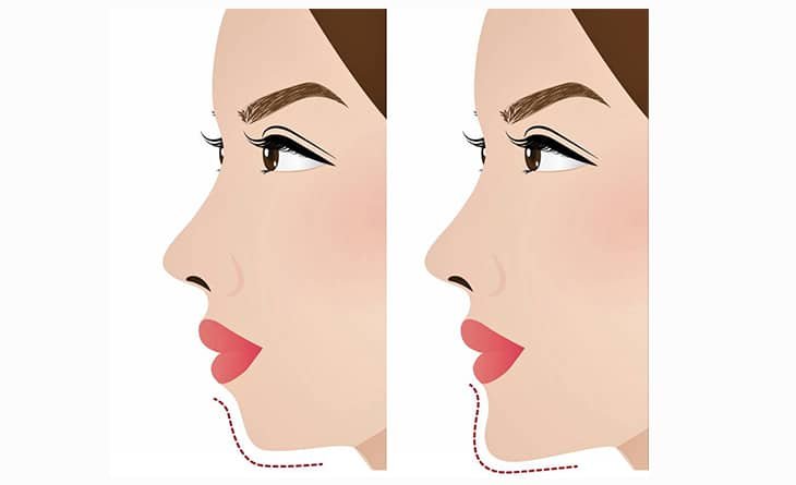 Is Bleeding After Chin Augmentation Normal - Dr Rajat Gupta - Best Plastic Surgeon in Delhi -02 Chin augmentation surgery