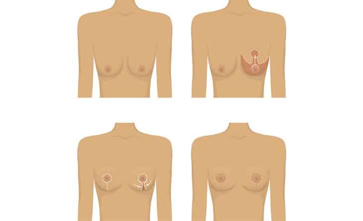 What to Expect After Breast Lift Surgery - Dr Rajat Gupta - Best Plastic Surgeon in Delhi -01 Breast Lift Surgery