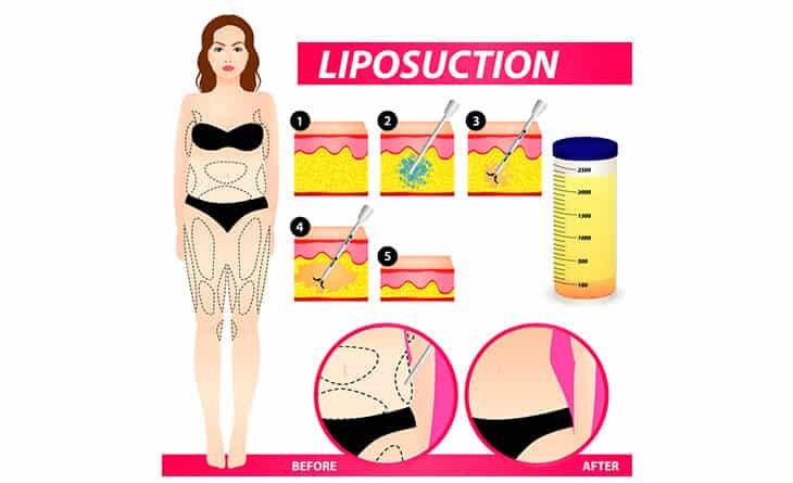 Is Liposuction Good for Obesity - Dr Rajat Gupta - Best Plastic Surgeon in Delhi - 911 Liposuction procedure
