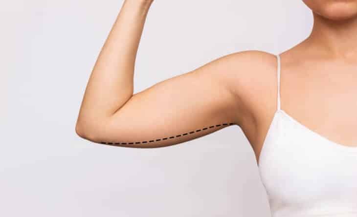 Alternatives to Arm Lift Surgery - Dr Rajat Gupta - Best Plastic suregon in delhi - 017 Arm lift surgery cost