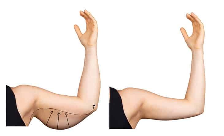 Complete Guide to Brachioplasty-Arm Lift Procedure - Dr Rajat Gupta - Best Plastic Surgeon in Delhi 02 Arm Lift Procedure