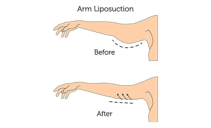 Complete Guide to Brachioplasty-Arm Lift Procedure - Dr Rajat Gupta - Best Plastic Surgeon in Delhi 03
