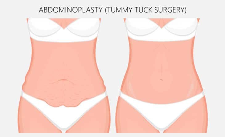 Complete Guide to Tummy Tuck in Delhi - Dr Rajat Gupta - Best Plastic Surgeon in Delhi - RG Aesthetiks 001 Tummy Tuck Procedure