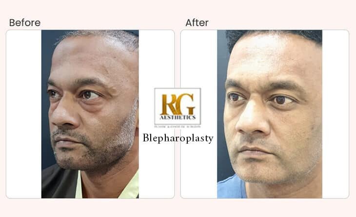 Blepharoplasty Surgery Before After Result - Dr Rajat Gupta - Best Plastic Surgon in Delhi Blepharoplasty Surgery Procedure