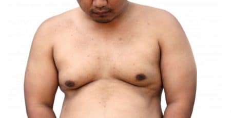Gynecomastia Surgery in Delhi