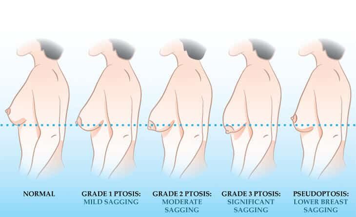 Complete Guide to Breast Augmentation - Dr Rajat Gupta - Best Plastic Surgeon in Delhi - RG Aesthetics 02 Breast Augmentation Procedure