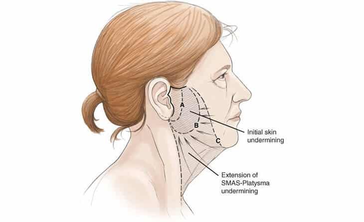 Complete Guide to Facelift - Dr Rajat Gupta - Best Plastic Surgeon in Delhi - RG Aesthetics 02 Face Lift Surgery Procedure