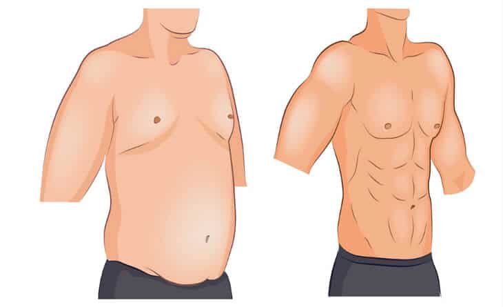 Complete Guide to Gynecomastia - Dr Rajat Gupta - Board Certified Plastic Surgeon in Delhi - RG Aesthetics 02 Male Breast Reduction Surgery