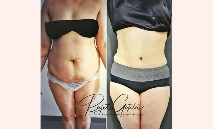 Tummy Tuck Surgery Before After Results - Dr Rajat Gupta - Best Plastic Surgeon in Delhi -01 Tummy Tuck Surgery Before After Results