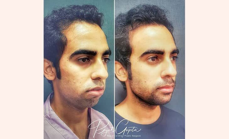 Chin Augmentation before after results - Dr Rajat Gupta - Plastic Surgeon in Delhi - RG Aesthetics 01 Chin Augmentation Procedure
