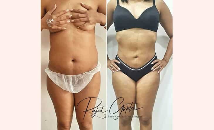 Liposuction Surgery Before After Results - Dr Rajat Gupta - Board Certified Plastic Surgeon - RG Aesthetics 01 Liposuction Surgery Before After Result