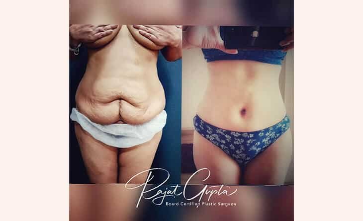 Tummy Tuck Surgery Before After Result - Mommy Makeover Surgery - Dr Rajat Gupta Plastic Surgeon in Delhi 01 Tummy Tuck Surgery Before After Result - Mommy Makeover Surgery - Dr Rajat Gupta Plastic Surgeon in Delhi 01