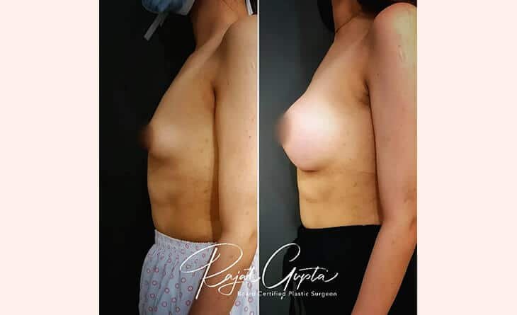 Breast Augmentation Before After Results-Dr-Rajat-Gupta-RG-Aesthetics-02 Breast Augmentation Procedure