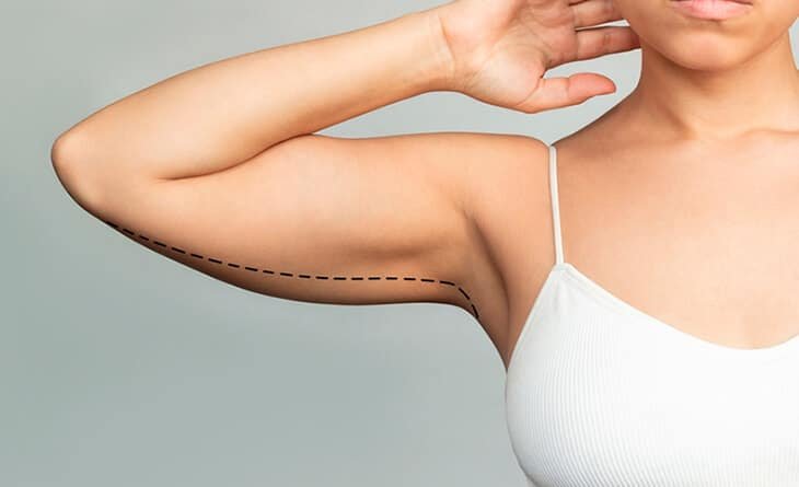 How Long Does A Brachioplasty Take to Heal - Arm Lift Surgery - Dr Rajat Gupta - RG Aesthetics Arm Lift Procedure