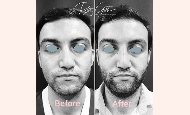 Rhinoplasty Before After Results - Dr Rajat Gupta - Best Plastic Surgeon in Delhi - RG Aesthetics Rhinoplasty Procedure