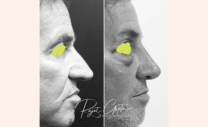 Rhinoplasty Surgery Before After Result - Rhinoplasty Surgery - Dr Rajat Gupta - Best Plastic Surgeon in Delhi Rhinoplasty Surgery Before After Result - Rhinoplasty Surgery - Dr Rajat Gupta - Best Plastic Surgeon in Delhi