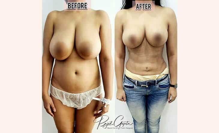 Breast Reduction Before After Results - Dr Rajat Gupta - Best Plastic Surgeon in Delhi- RG Aesthetics Breast Reduction Before After Results