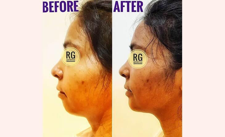 Chin Augmentation Before After Results - Dr Rajat Gupta - Best Plastic Surgeon in Delhi - RG Aesthetics Chin Augmentation Before After Results
