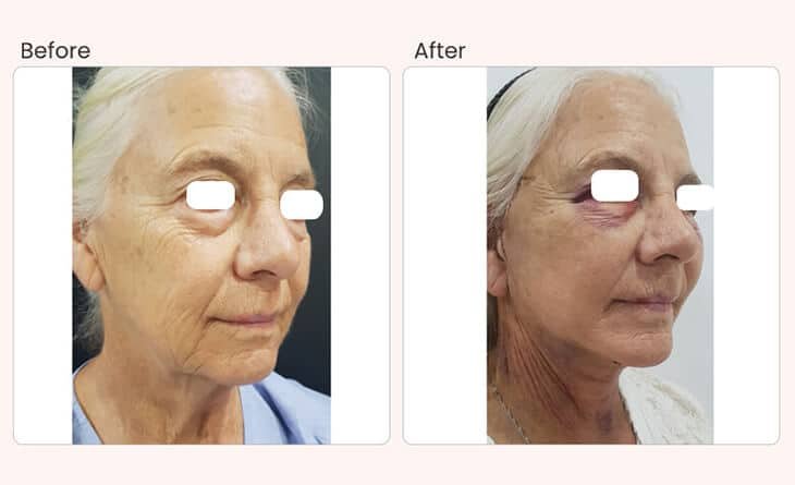Facelift Before & After- Dr Rajat Gupta - Best Plastic Surgeon in Delhi - RG Aesthetics Facelift Before & After