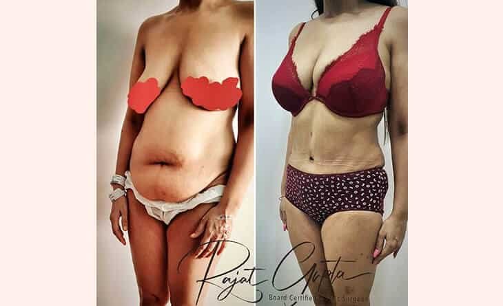 Liposuction Surgery Before After Results - Liposuction Procedure - Dr Rajat Gupta - Plastic Surgeon in Delhi -01 Liposuction Surgery Before After Results - Liposuction Procedure