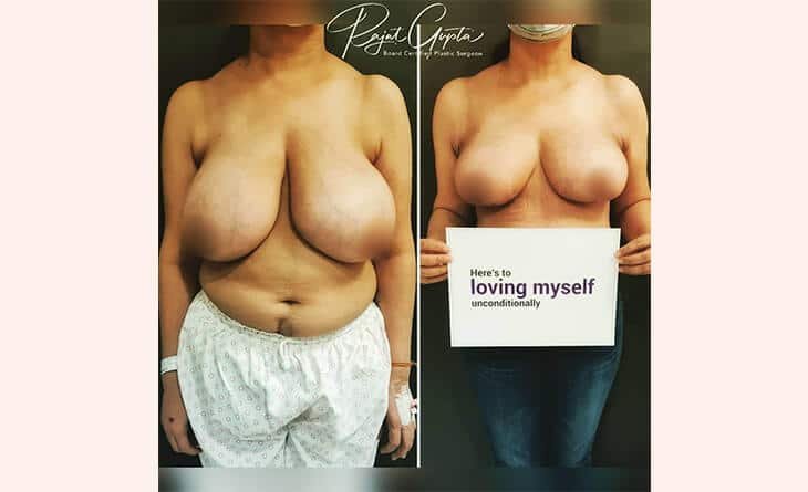 Breast-Lift-and-Breast-Reduction-Dr-Rajat-Gupta-Before-After-Results-RG-Aesthetics-02 Breast-Lift-and-Breast-Reduction Before After Results
