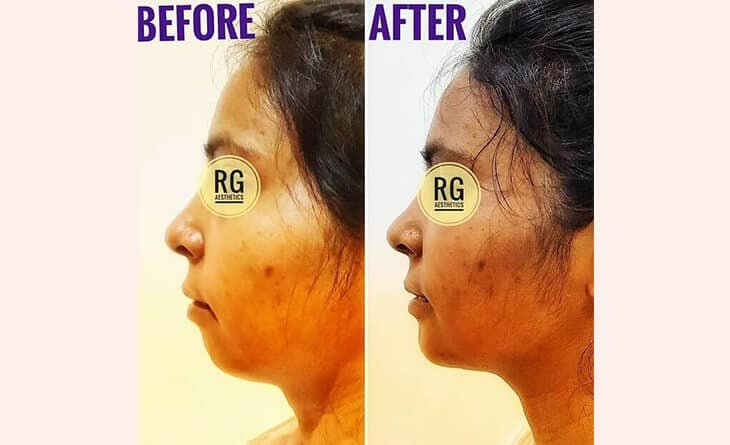 Chin Augmentation Before After Results- Chin Augmentation Procedure - Dr Rajat Gupta - Best Plastic Suregon in Delhi Chin Augmentation Before After Results- Chin Augmentation Procedure - Dr Rajat Gupta - Best Plastic Suregon in Delhi