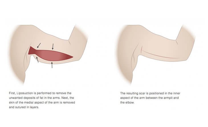Complete Guide to Brachioplasty - Arm lift - Dr Rajat Gupta - RG Aesthetics Arm Lift Procedure