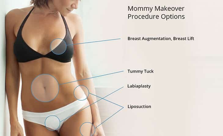 Tummy tuck procedure
