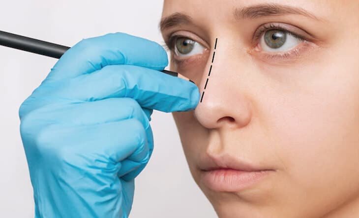 Complete Guide to Rhinoplasty - Nose Job - Dr Rajat Gupta - Best Plastic Surgeon in Delhi - RG Aesthetics 01 rhinoplasty procedure