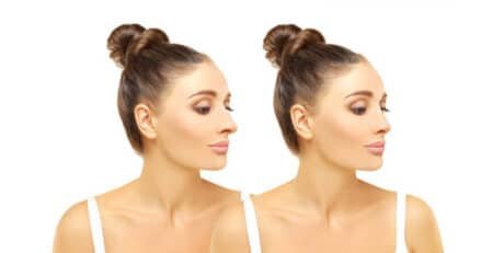 rhinoplasty procedure