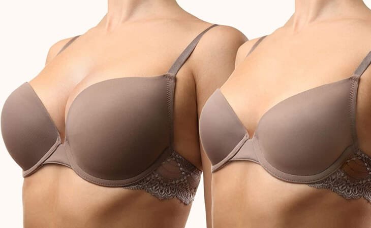 Do Breasts Grow Back After Reduction - Dr Rajat Gupta - Best Plastic Surgeon in Delhi-02 Breast reduction surgery procedure