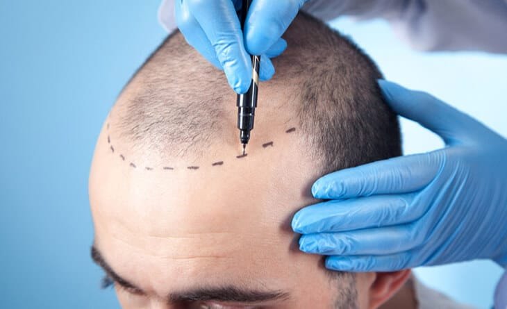 What Are The 2 Types Of Hair Transplant - Dr Rajat Gupta - Best Plastic Surgeon in Delhi -02 Hair transplant procedure