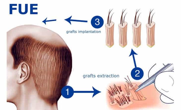 What Are The 2 Types Of Hair Transplant - Dr Rajat Gupta - Best Plastic Surgeon in Delhi -03 Hair transplant procedure