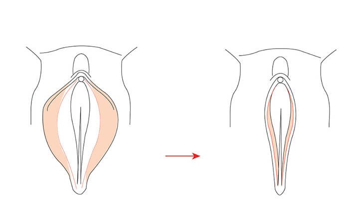 What is Vaginal Rejuvenation - Vaginal Tightening Procedure- Dr Rajat Gupta - RG Aesthetics Vaginal Tightening Procedure