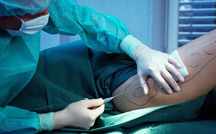 Is Liposuction Safe - Liposuction procedure - Dr Rajat Gupta - RG Aesthetics Liposuction procedure