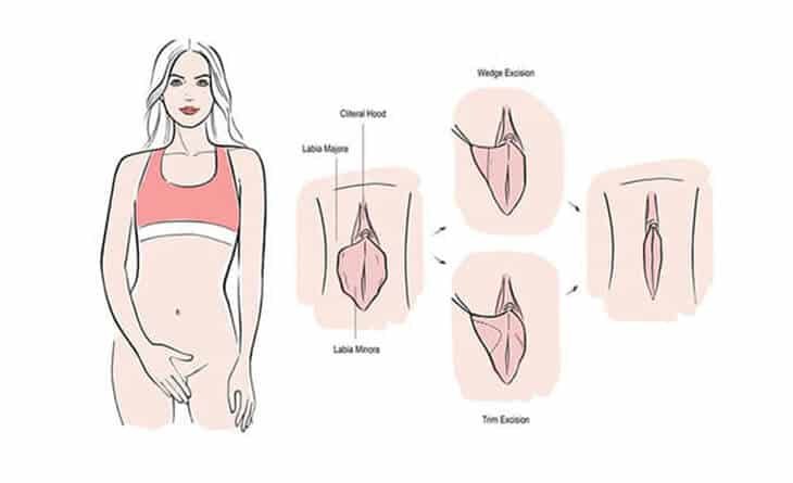 What is a Vaginal Tightening Procedure - Vaginal Tightening Procedure - Dr Rajat Gupta - Best Plastic Suregon in Delhi -1 Vaginal Tightening Procedure