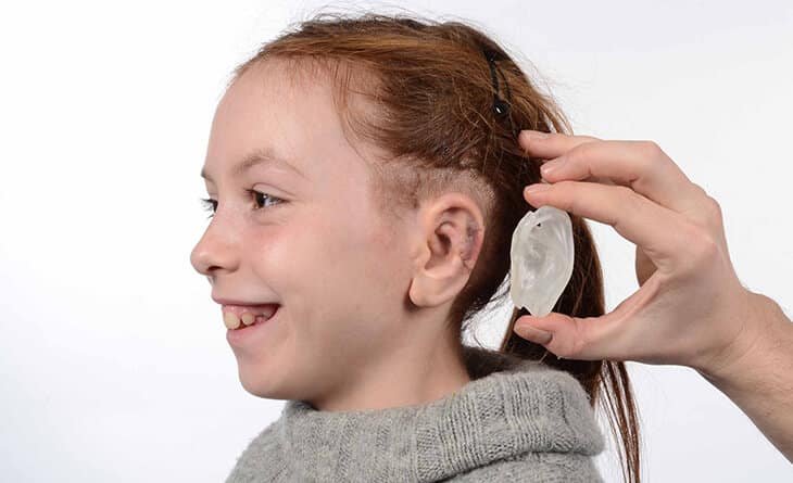 Can You Fix the Microtia - Dr Rajat Gupta - Best Plastic Surgeon in Delhi -02 Microtia surgery