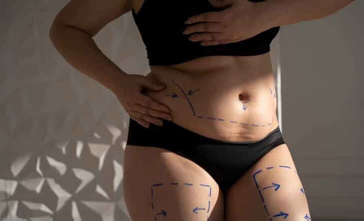 Does Liposuction Permanently Remove Fat - Dr Rajat Gupta - Plastic Surgeon in Delhi-02 Liposuction procedure