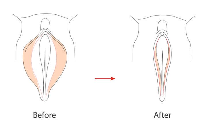 What are the Side Effects of Vaginal Tightening Surgery - Dr Rajat Gupta - Best Plastic Surgeon in Delhi -02 Vaginal Tightening Procedure
