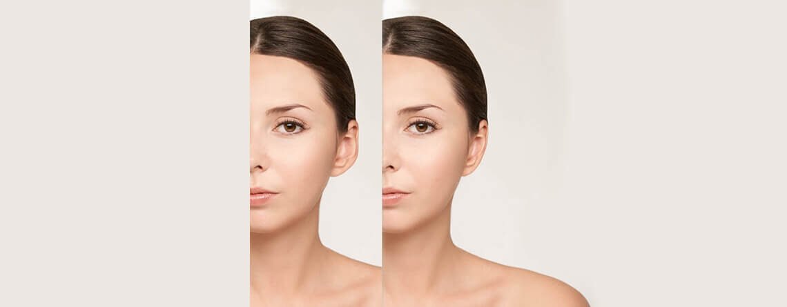 Otoplasty Surgery in Delhi