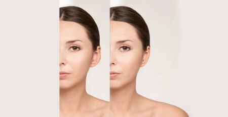 Otoplasty Surgery in Delhi