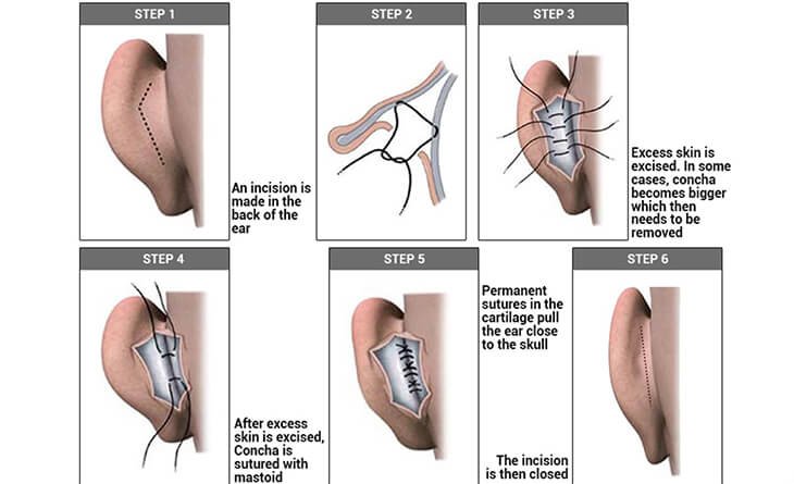 How Long Does Otoplasty Surgery Take - Dr Rajat Gupta - Best Plastic Surgeon in Delhi -02 Otoplasty Surgery in Delhi