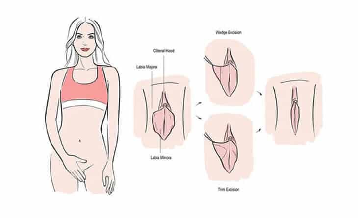 Vaginal Rejuvenation, Labiaplasty, and Other Female Genital Cosmetic Surgery - Dr Rajat Gupta - RG Aesthetics -03 Vaginal tightening surgery in Delhi