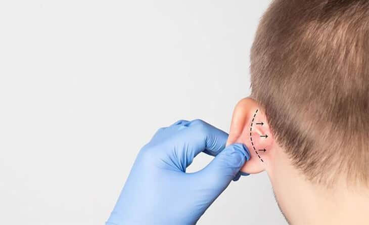 Are the Results of Otoplasty Permanent - Dr Rajat Gupta - Best Plastic Surgeon in Delhi -RG Aesthetics Otoplasty Surgery