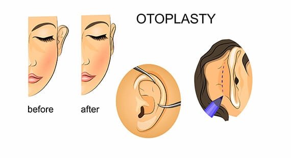 How Should You Prepare For Otoplasty Otoplasty Surgery