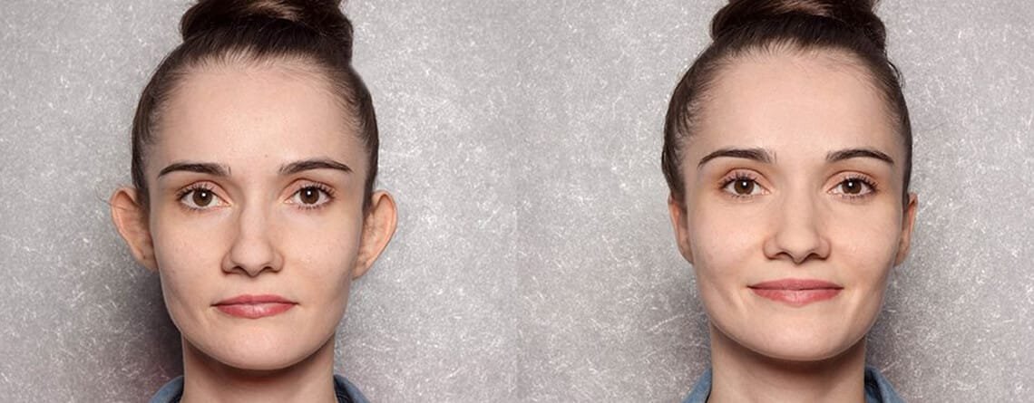 Procedure of Otoplasty Surgery